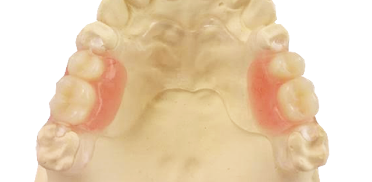 Karadent-with-acrylic-saddles